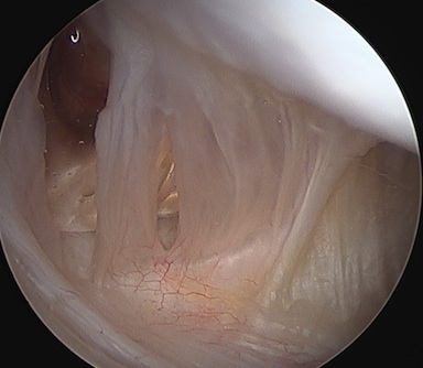 Capsular Tear 1